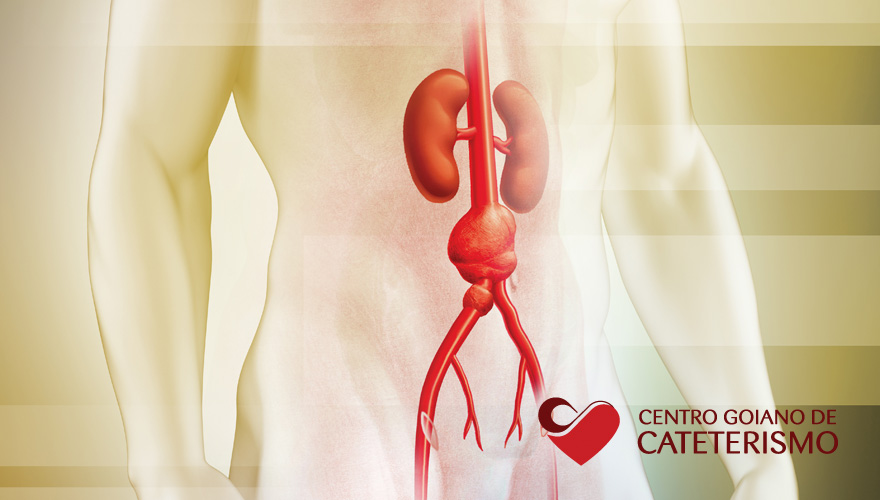 Homens com idade acima de 60 anos são mais propensos a desenvolverem um aneurisma aorta abdominal