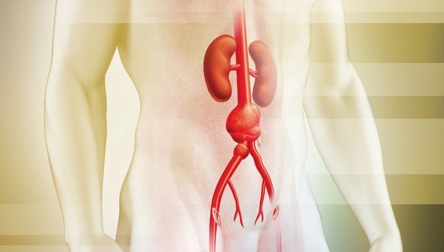 Entenda como é feito o implante de stent em casos de Aneurima na Aorta